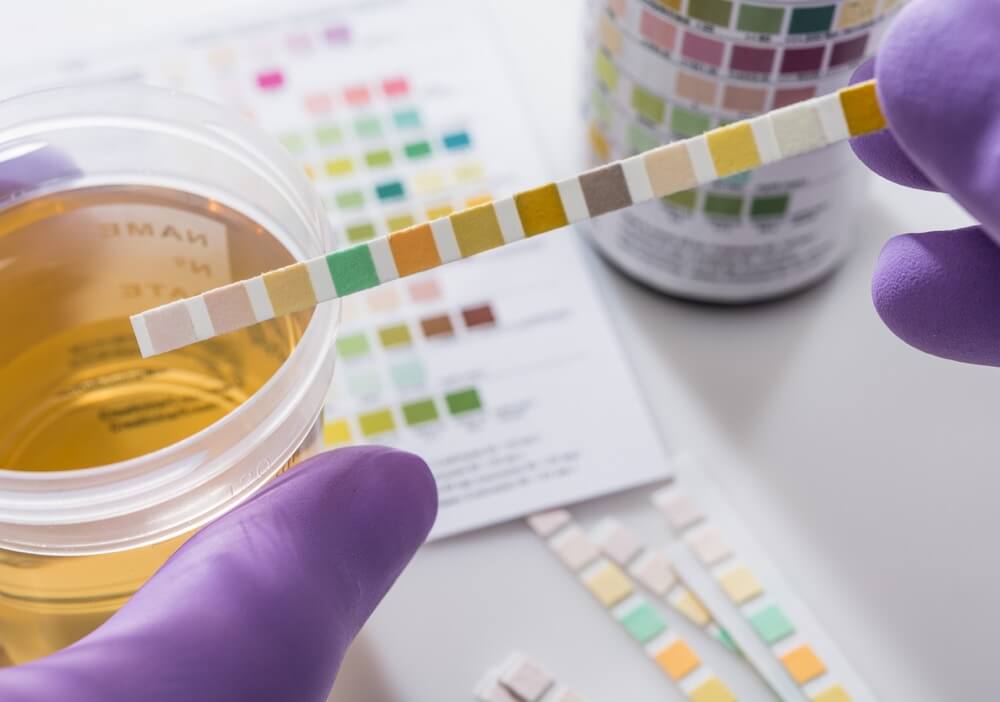 test of TCH level in urine